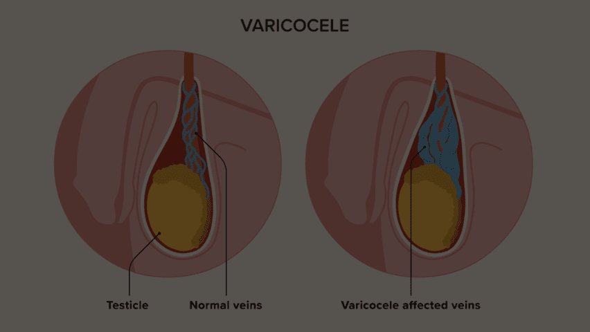 l carnitine varicocele Can varicocele be treated without surgery? Options explained